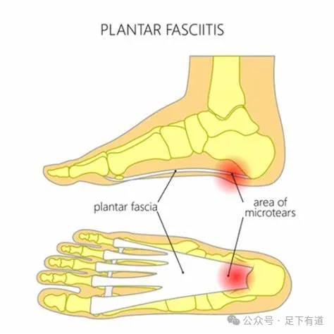 Plantar Fasciitis: Causes, Symptoms & Treatment - Dr Foot Podiatry