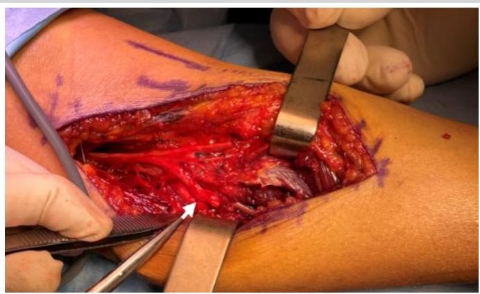 Neuroma of the posterior interosseous nerve (arrow)