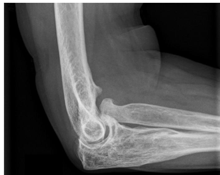 Lateral radiograph showing anterior dislocation of the radial head