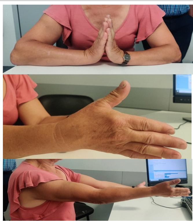 Thumb, wrist and elbow extension 1 year postoperative